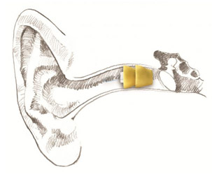 Lyric hearing aid
